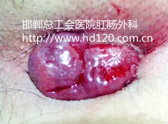 PPH技术快速根除内痔