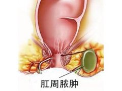 肛周脓肿